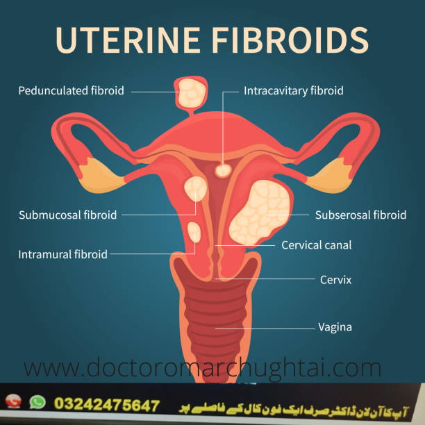 how febroids grow in women