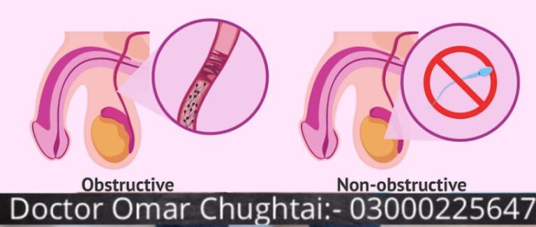non obstructive azoospermia