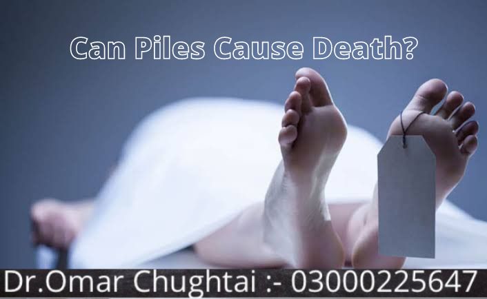Can piles cause death? | Kiya Bawaseer Mout Ki Wajah Ban Sakti Ha