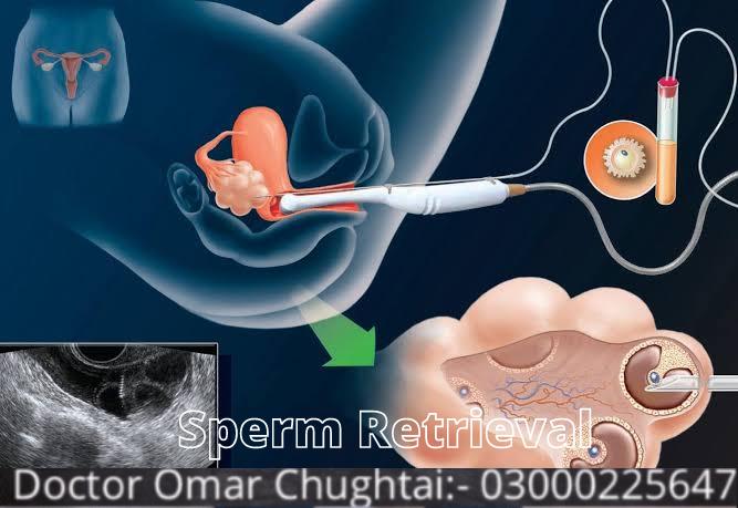 What is Sperm Retrieval Procedures?