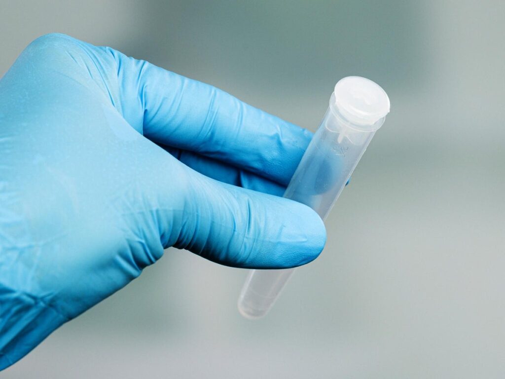 Blocked Sperm Ducts And Sperm Disorders Causes and Diagnosis