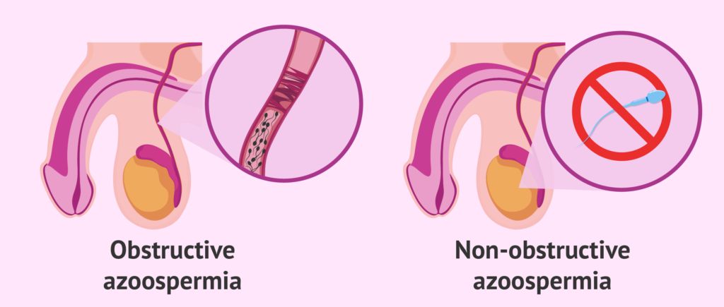Non Obstructive Azoospermia | Male Infertility