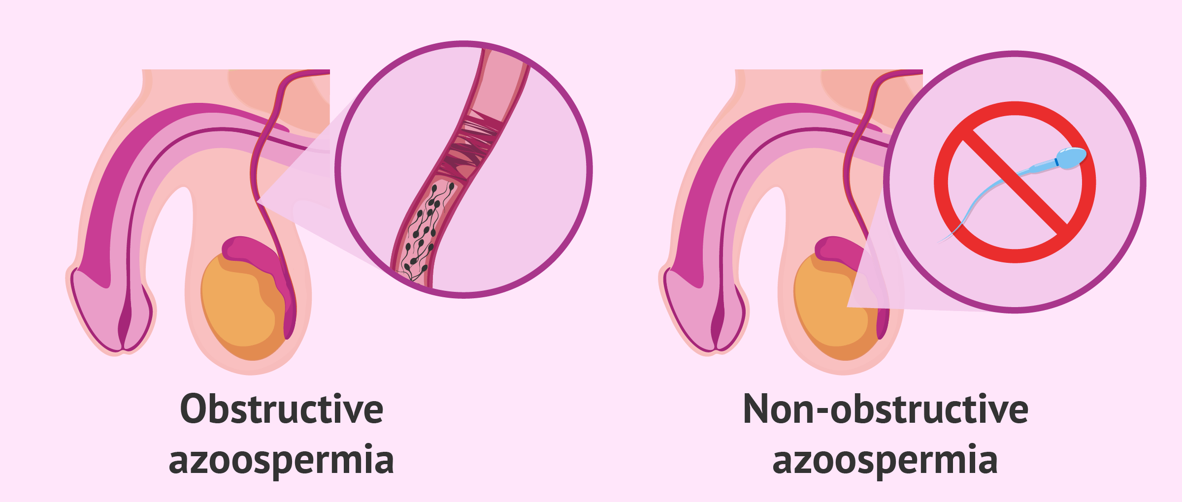 Everything You Need To Know About Non Obstructive Azoospermia