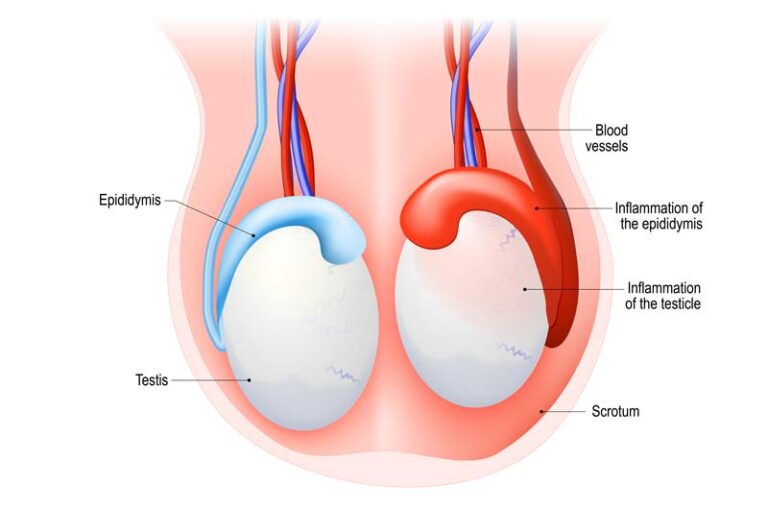 What Is The Epididymis Blockage?