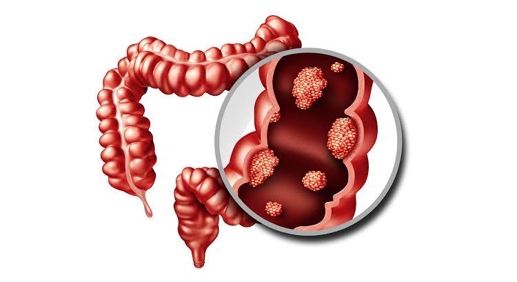 Hemorrhoids Vs Colon Cancer Is It Hemorrhoids Or Colon Cancer