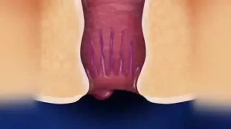 How Do I Prevent Hemorrhoids? - Causes & Symptoms Of Hemorrhoids