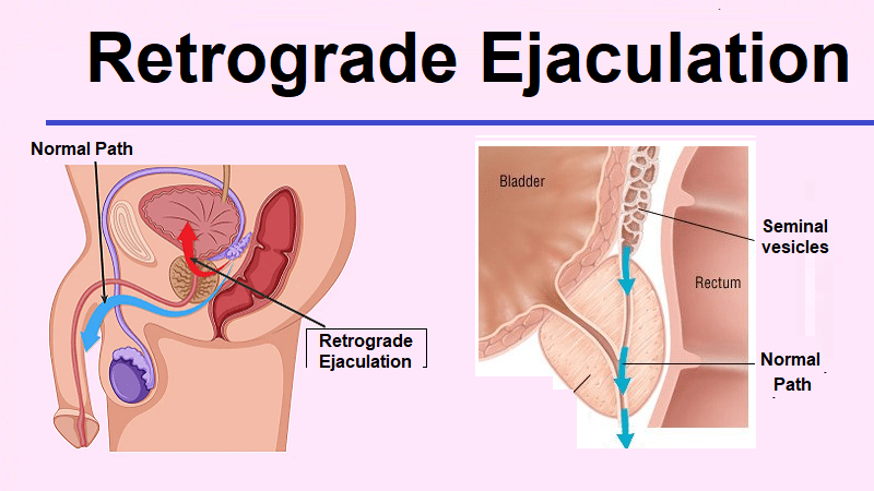 How To Treat Retrograde Ejaculation? | Causes, Symptoms and Treatment