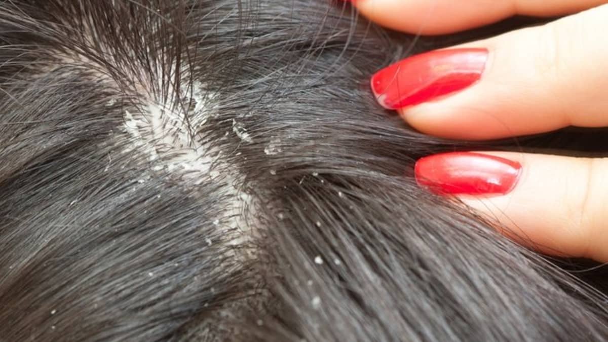 Home Remedies & Products To Remove Dryness From Your Scalp