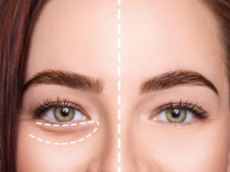 remove dark circles from face