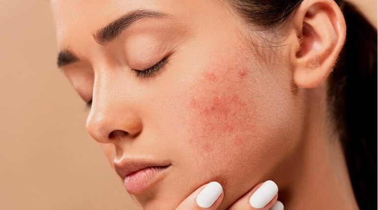 Quick and easy home remedies for acne