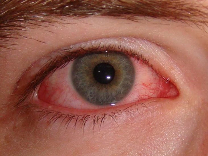 What causes eye infections?