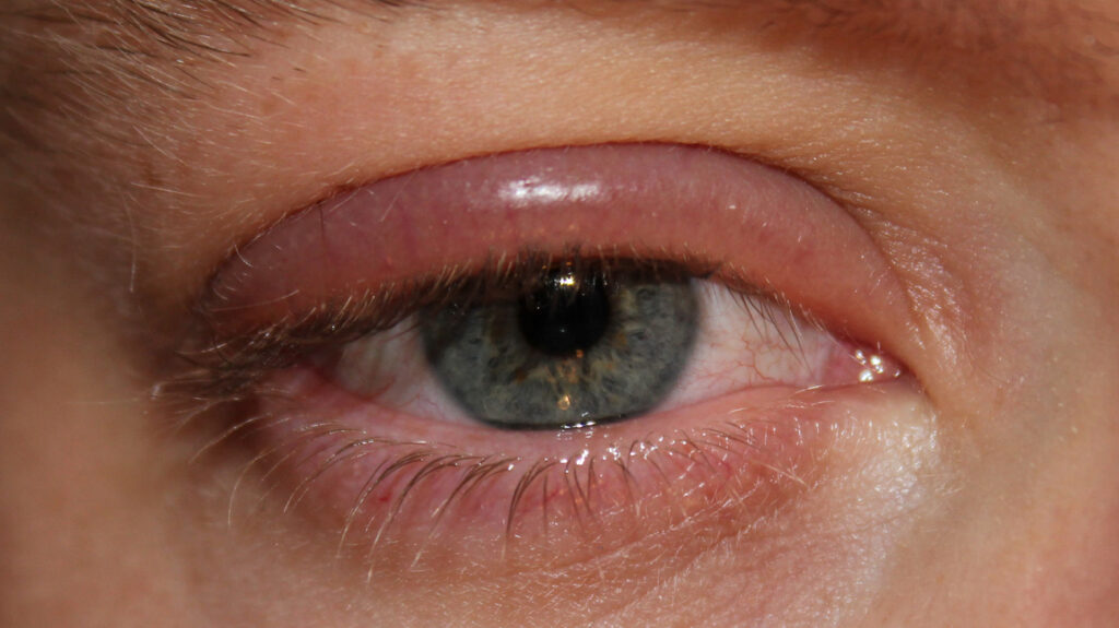 How to cure an eye infection in just 24 hours?