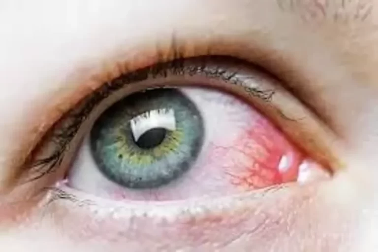 What to do for an eye infection? 5 Easy Home Remedies