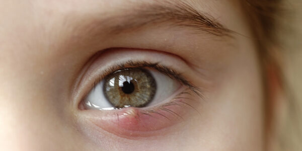 What causes eye infections? - Doctor Omar Chughtai