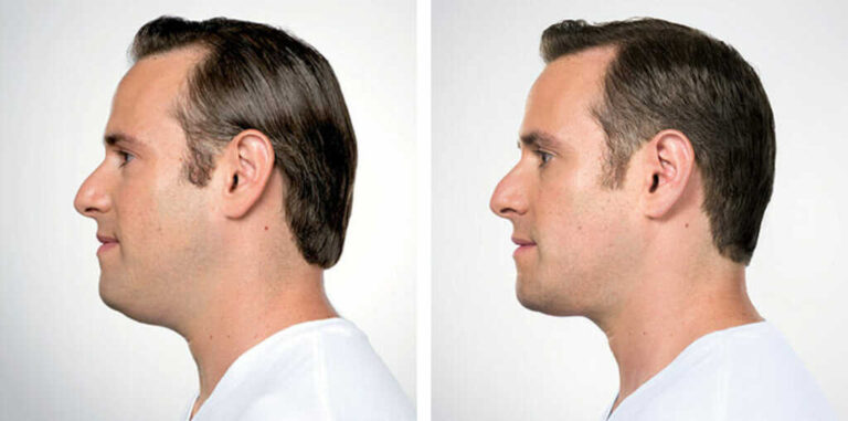 How To Reduce Face Fat Naturally? 8 Effective Ways