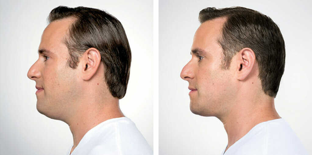 How To Reduce Face Fat Naturally? 8 Effective Ways